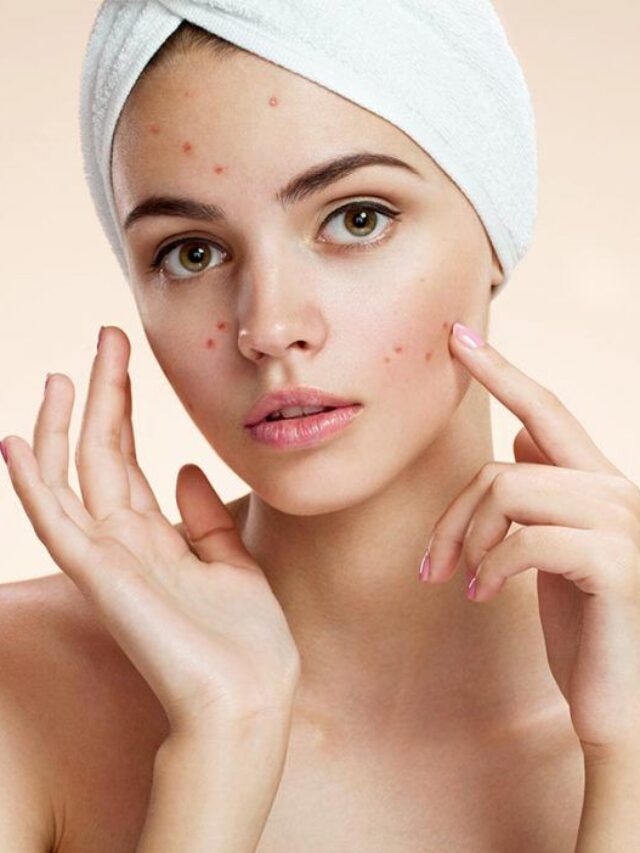 9 TIPS TO GET RID OF PIMPLES FAST