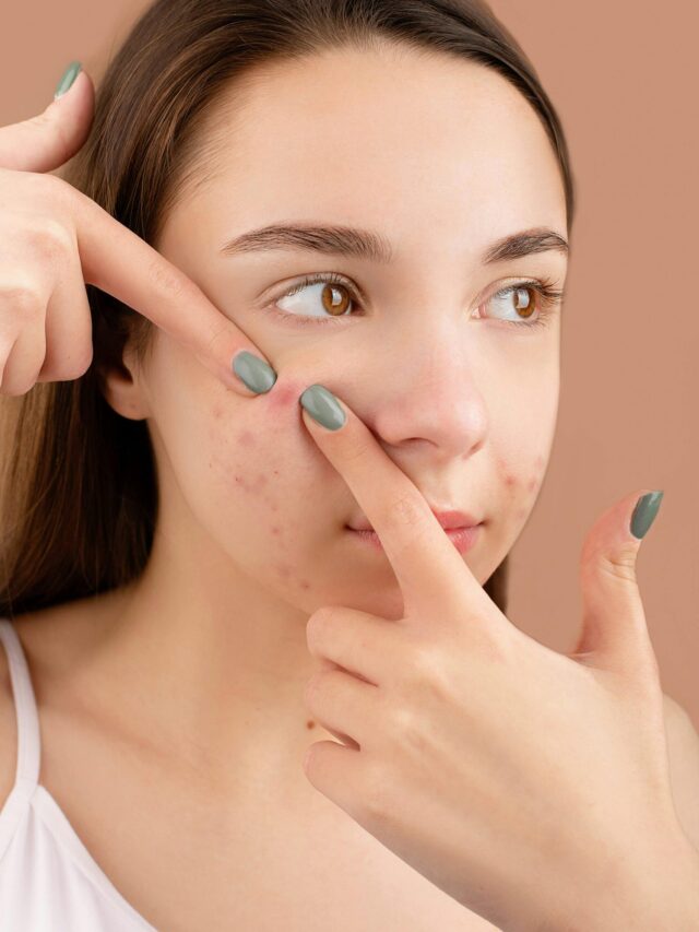 How to Get Rid of Acne: 9 Easy tips for pimples